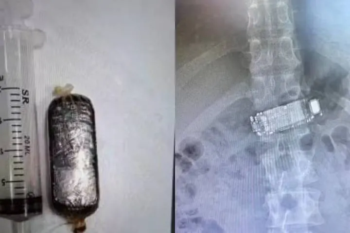 Celular fica atravessado no estômago após detento engolir aparelho em Rio do Sul