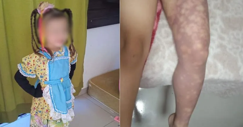 Menina de 4 anos tem perna amputada após suspeita de erro na aplicação de injeção em Três Barras