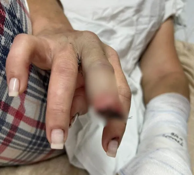 Mulher é espancada e tem dedo arrancado por mordida de enteado em Barra Velha 
