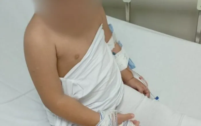 Menina tem a mão queimada pela madrasta no bairro Cordeiros em Itajaí