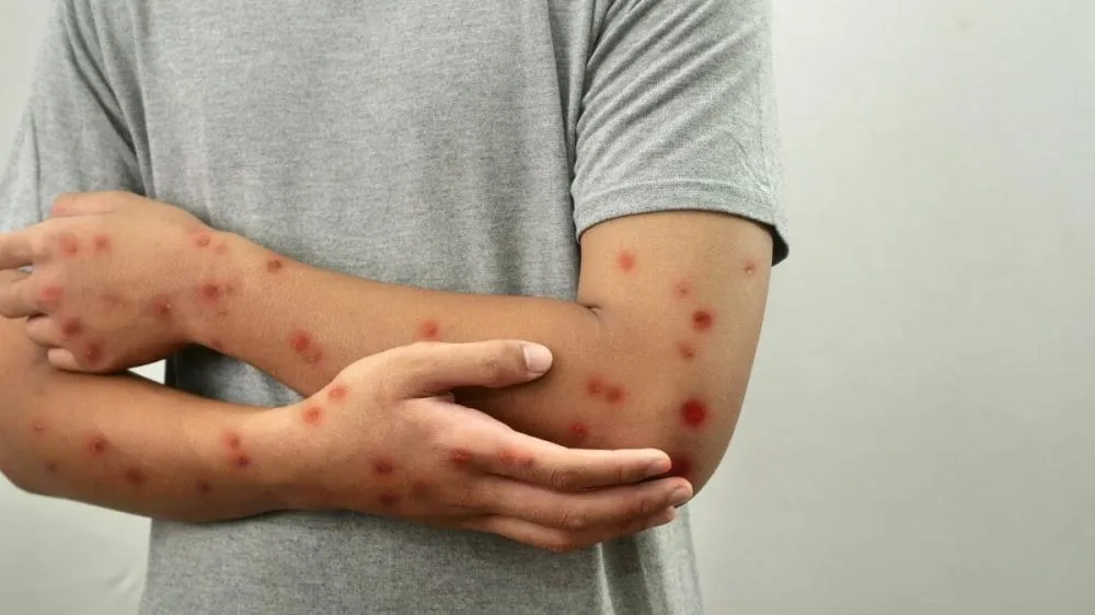 Número de casos suspeitos de Mpox em SC chega a 16