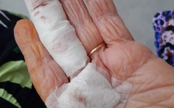 Cadeiras enferrujadas quebram em postinho e deixam idosos feridos