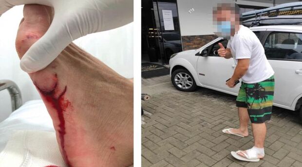 Beliscada: Surfista teve o pé mordido por tubarão mangona na praia Central de Navegantes