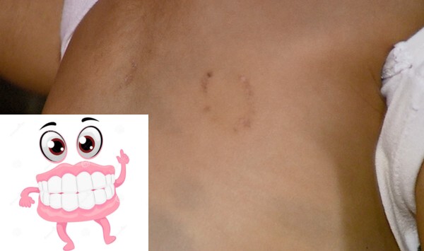 Dentaduras afiadas: Casal troca mordidas após discussão em Massaranduba