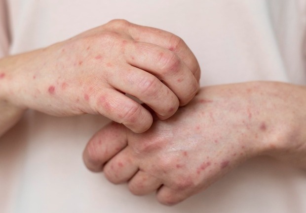 Varíola dos Macacos - Balneário Piçarras registra primeiro caso de Monkeypox