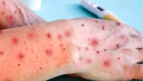 Monkeypox – Barra Velha registra primeiro caso de Varíola dos Macacos