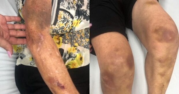 Itajaí - Idosa dá entrada em UPA de Cordeiros com inúmeros hematomas e denuncia estupro com tudo de desodorante
